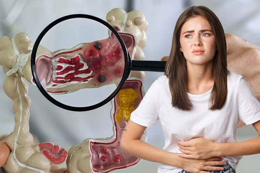 Causes of bloating in ulcerative colitis