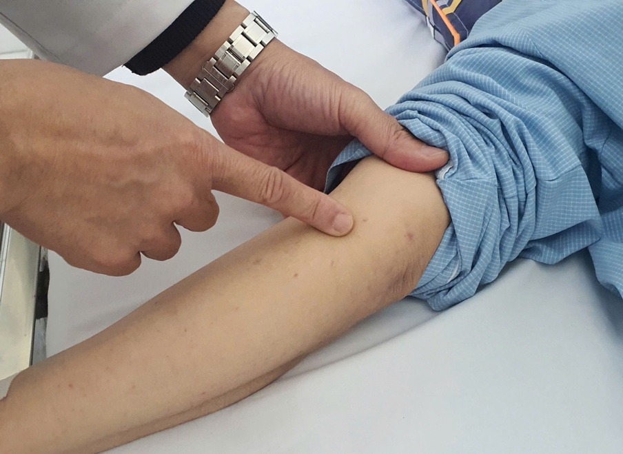 Marrow disease with necrotizing hemorrhage on the patient's skin. Photo: Nguyen Ha