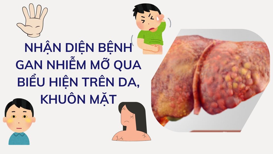 Identifying fatty liver disease through skin and face manifestations