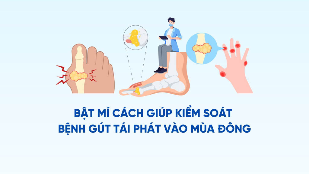 Revealing ways to help control gout recurrence in winter