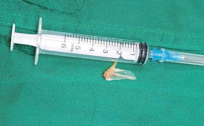The foreign object stuck in the bronchi was removed by a team of doctors. Photo: Vietnam - Cuba Dong Hoi Friendship Hospital