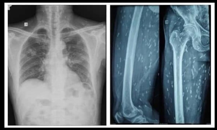 A thigh X-ray and chest CT scan showed that there were countless strep cysts in the brain, lung tissue, skin and muscles throughout the patient's body. Photo: BVCC