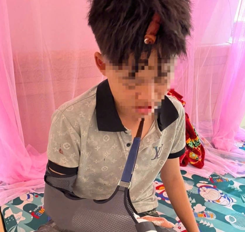 Em P.V.D (học sinh lớp 10, tỉnh Đắk Lắk) bị đánh gãy xương, chấn thương vùng đầu phải nhập viện điều trị. Ảnh: Uy Nguyễn