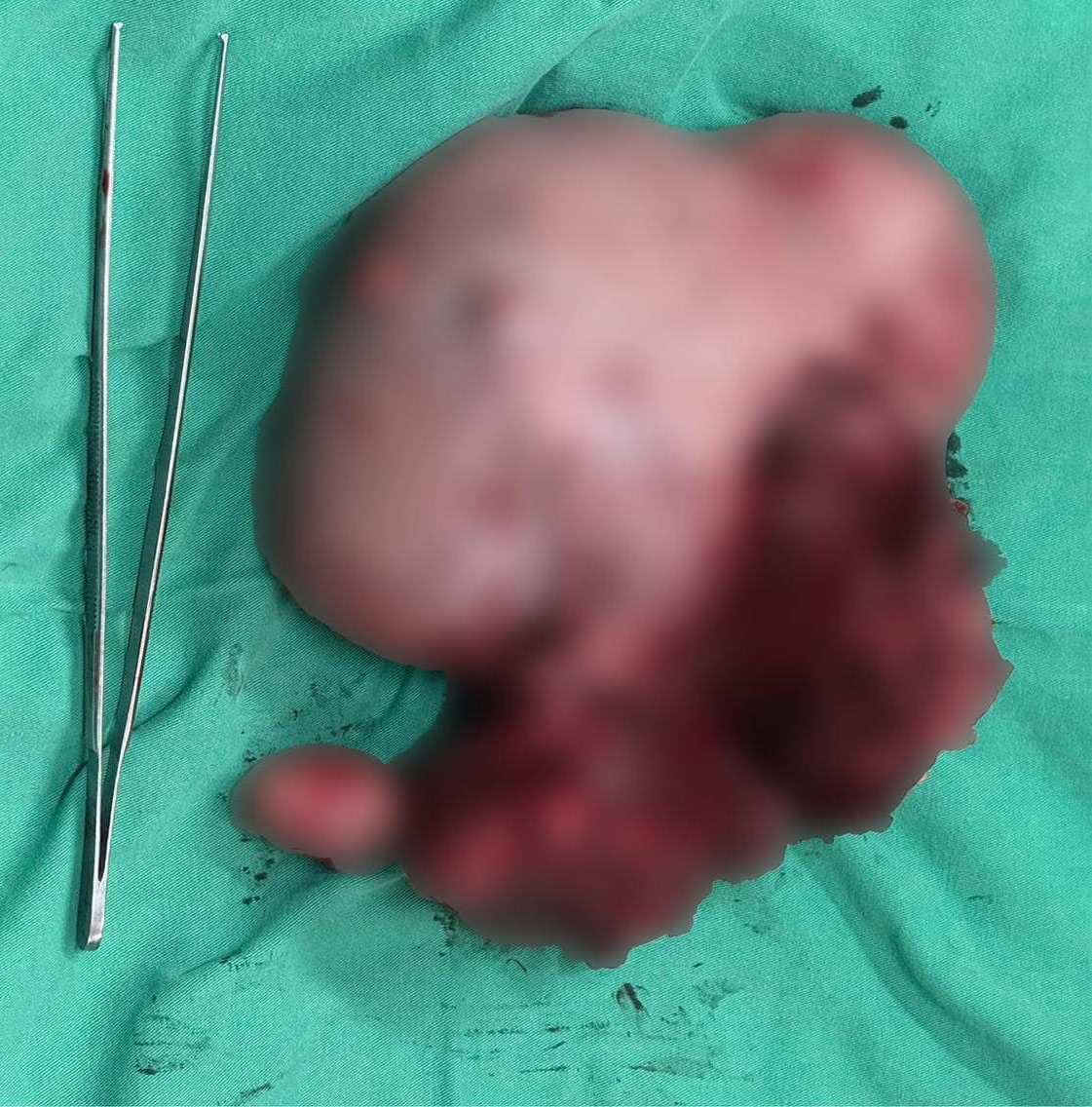 Khối u xơ tử cung nặng 2,8kg được lấy ra thành công. Ảnh: BVCC