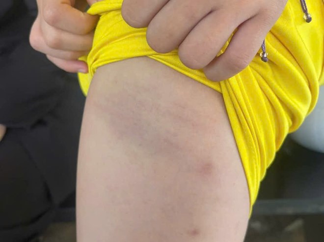 The bruises on the body of a student at Ly Tu Trong Primary School. Photo: Bao Trung