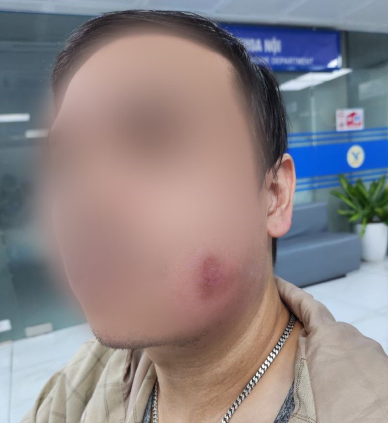 Pacientes con infecciones graves solo por un pequeño rasguño en la cara. La imagen de la mejilla izquierda del paciente esta hinchada y roja. Foto: BVCC