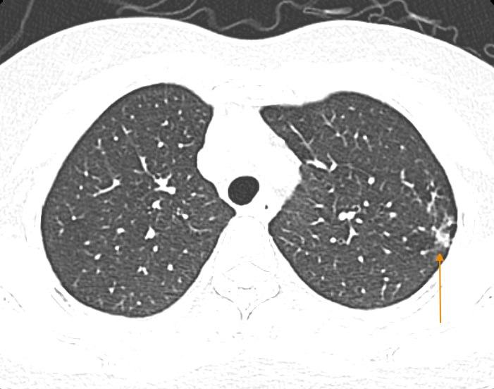 Pictures of the pulmonary component of the patient with flu detects damage. Photo: BVCC
