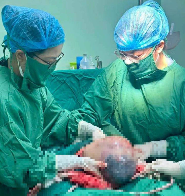 The baby boy was born in the amniotic sac and was safely delivered by surgery by doctors at Nghe An Obstetrics and Pediatrics Hospital. Photo: HOANG YEN