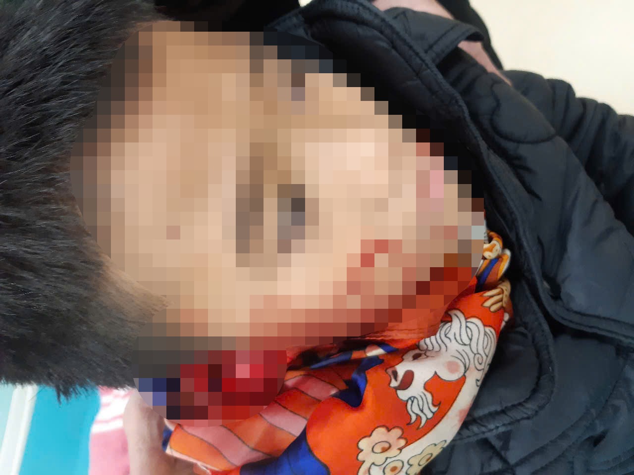 The boy was bitten by a dog on the head and arm, almost losing his ear. Photo: BVCC