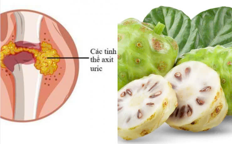 The fruit helps reduce uric acid effectively. Graphics: Huong Giang