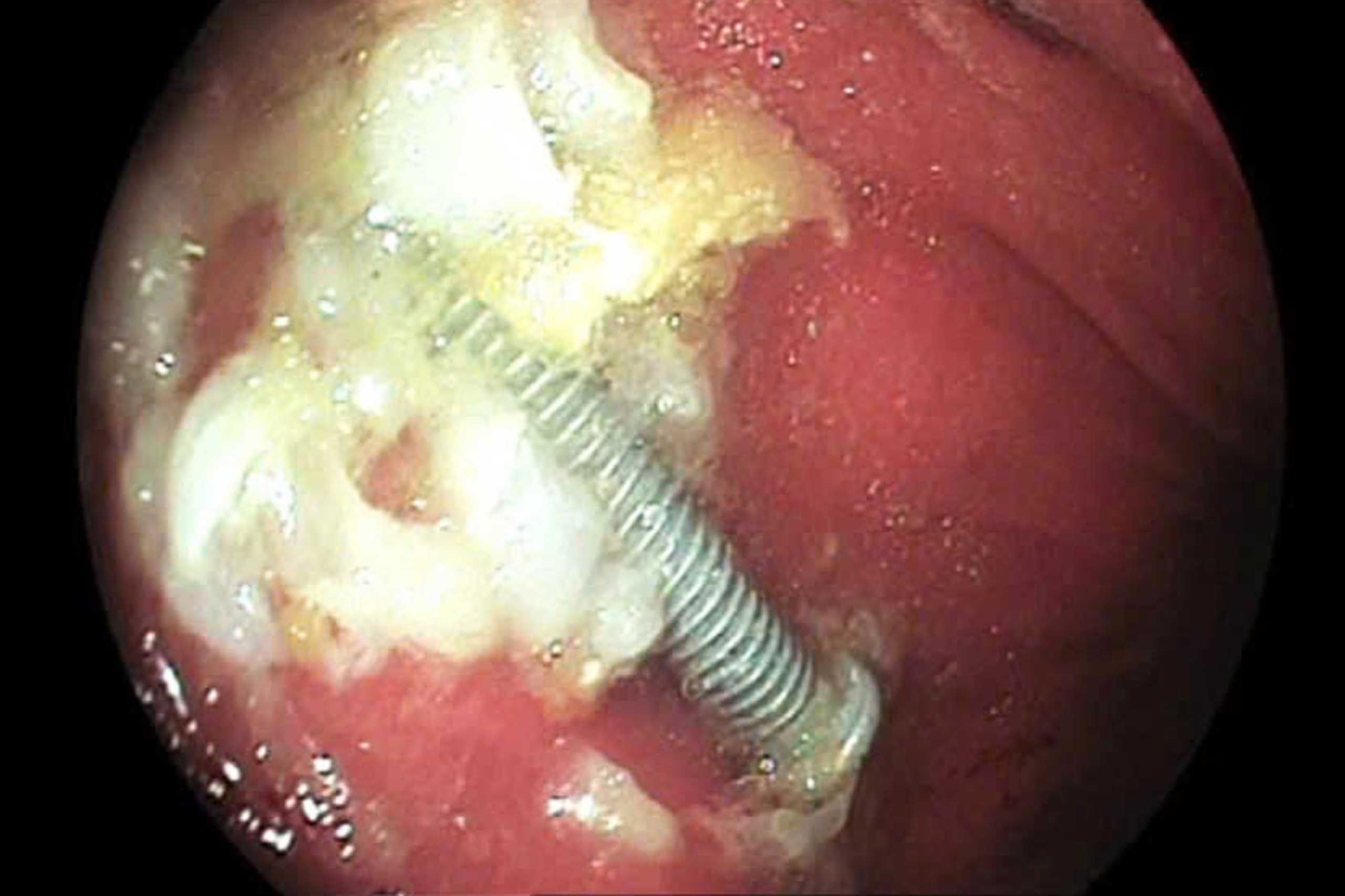 Image of a 5 cm long nail in the stomach of a 15-month-old boy in Nghe An. Photo: Anh Ngoc