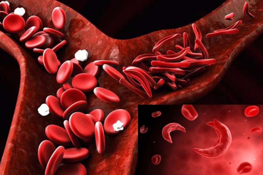 Difficulty breathing after exercise can be one of the signs of sickle cell anemia. Graphic: Ngoc Thuy