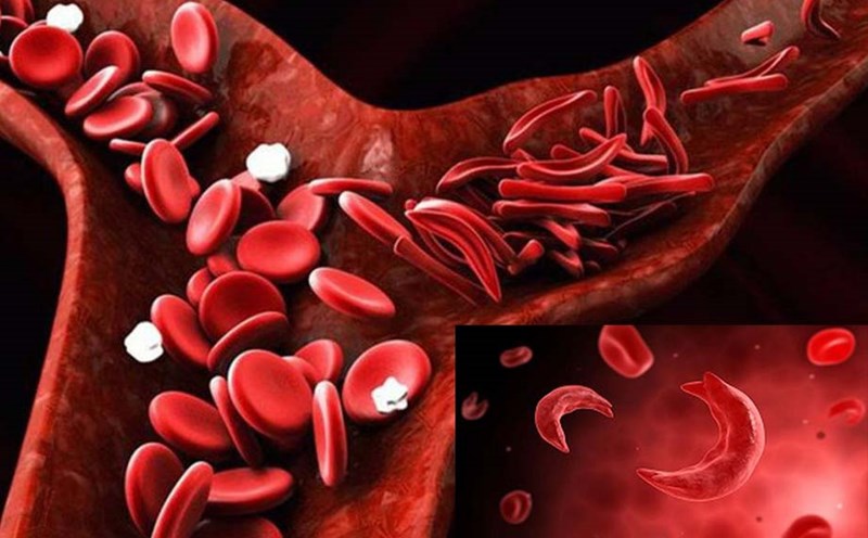 Difficulty breathing after exercise can be one of the signs of sickle cell anemia. Graphic: Ngoc Thuy