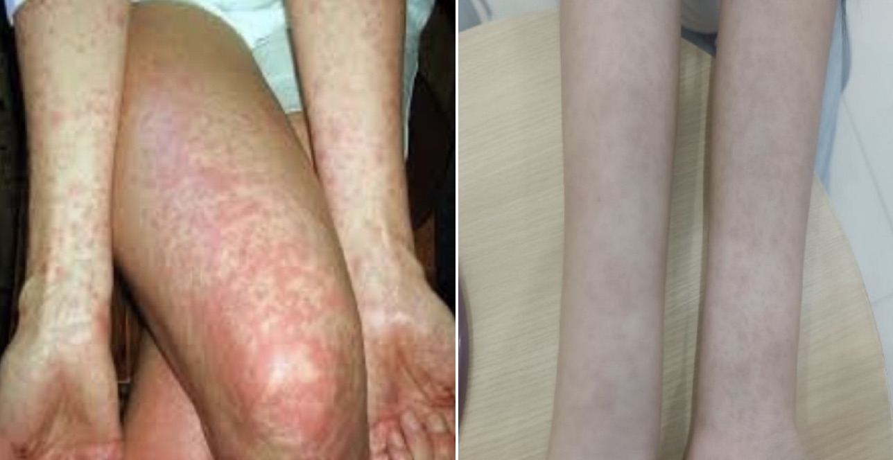 The girl had a high fever, rash, and went to 2 places to be diagnosed with the disease. Photo: BVCC