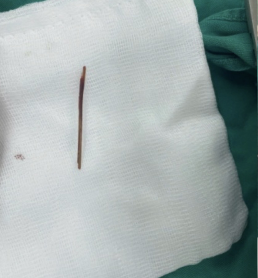 The bamboo toothpick that stuck through the stomach was removed. Photo: Thanh Dang
