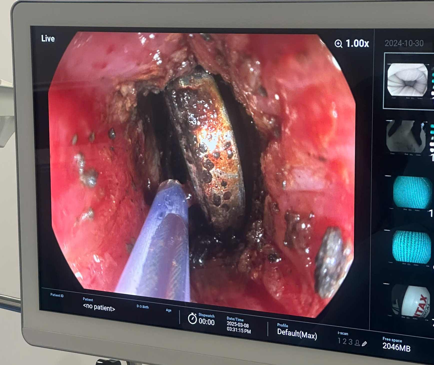Doctors are performing emergency endoscopy to remove the foreign object, the chamomile battery, from the patient's esophagus. Photo: Provided by Hanoi Children's Hospital