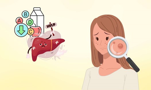 Những bộ phận trên cơ thể tố cáo tình trạng sức khỏe gan
