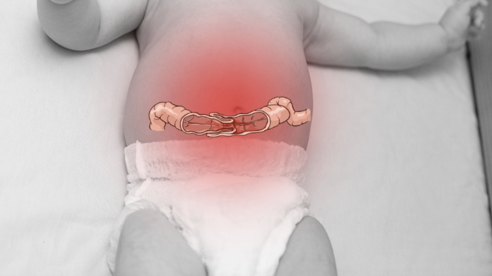 The child with intestinal complications was successfully treated. Photo: Provided by the hospital