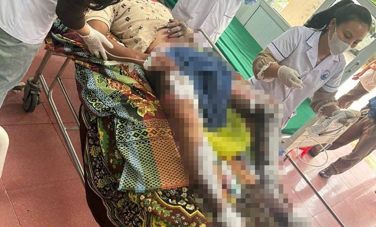 Mr. L.V.G. suffered severe burns from a phone explosion. Photo: Ngoc Anh