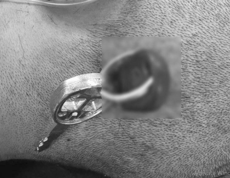 The key stuck through the patient's skull. Photo: BVCC