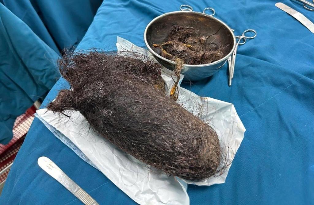 The baby's hair in Quang Ngai was removed from the stomach by surgeons. Photo: Kim Ny.