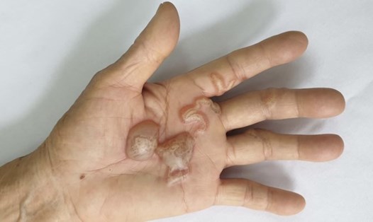 Ấu trùng giun móc chó, mèo tạo đường hầm và gây tổn thương trên da người. Ảnh: Bệnh viện cung cấp