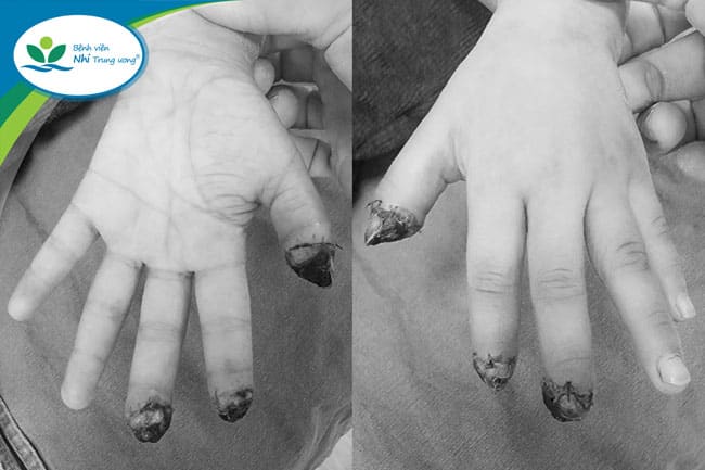 5-year-old child lost 3 fingers due to a cup lid crusher. Photo: BVCC