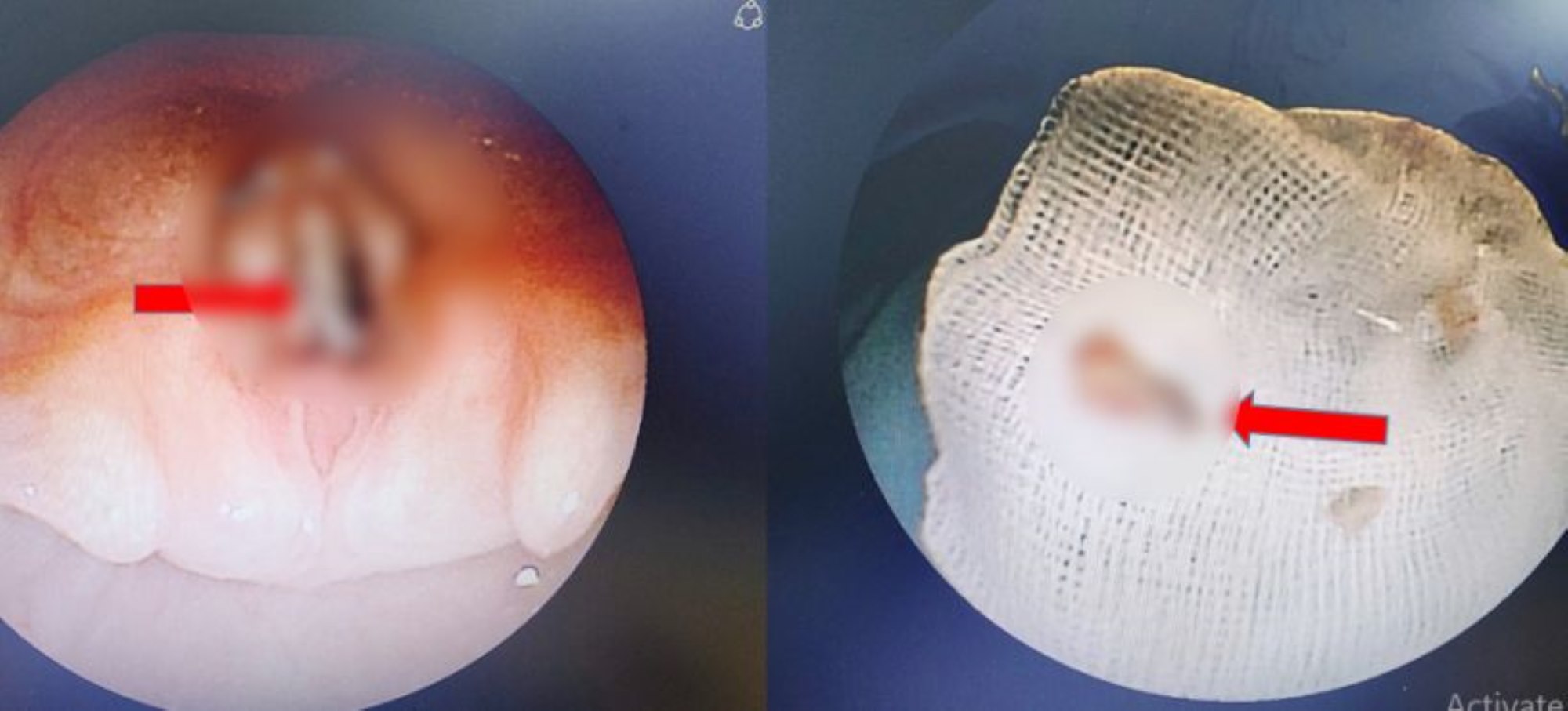 The foreign object is a piece of chicken bones when endoscoping the airway and when it is removed. Photo: Provided by Ho Chi Minh City Children's Hospital