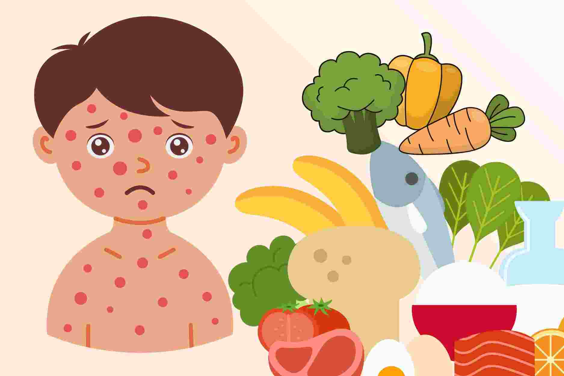 Nutritious foods increase resistance for children with measles