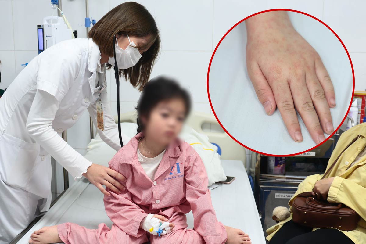 Measles is rampant, children have not had a fever for 6 consecutive days