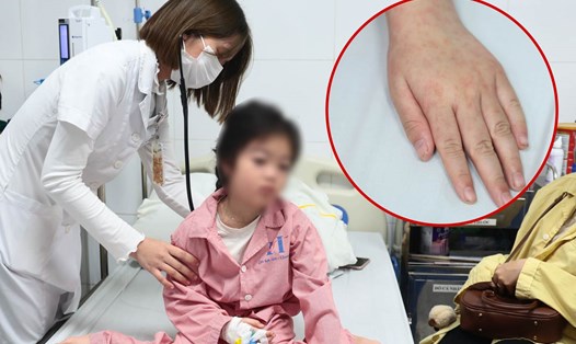 Bệnh sởi hoành hành, bệnh nhi liên tục 6 ngày chưa cắt sốt