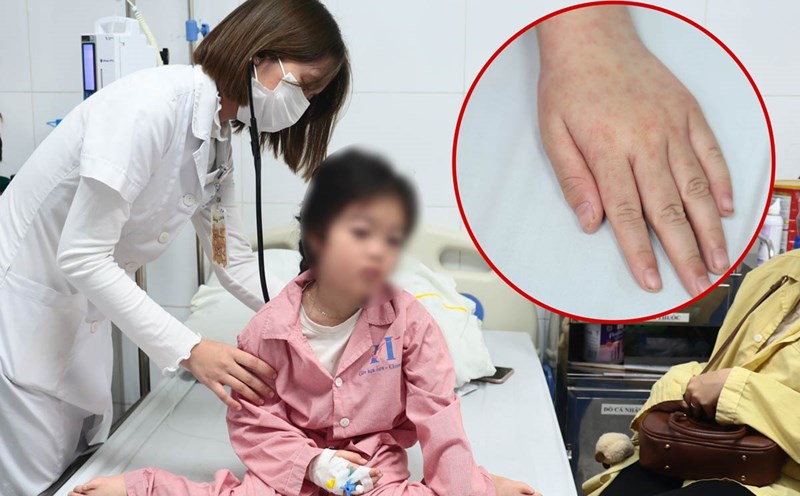 Measles is rampant, children have not had a fever for 6 consecutive days