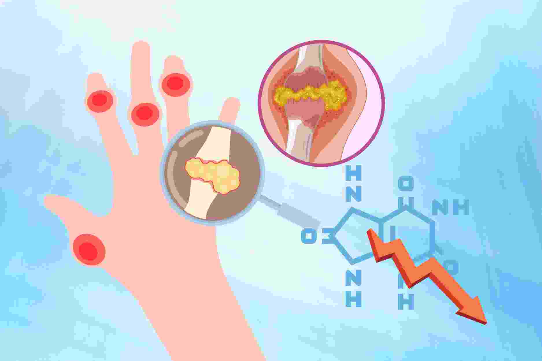 2 special notes to help you reduce uric acid at home. Graphics: Dinh Dinh
