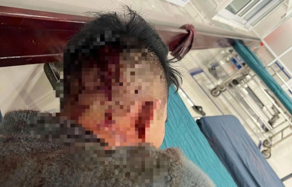 Mr. H was assaulted and suffered a head injury. Photo: Huyen Trang