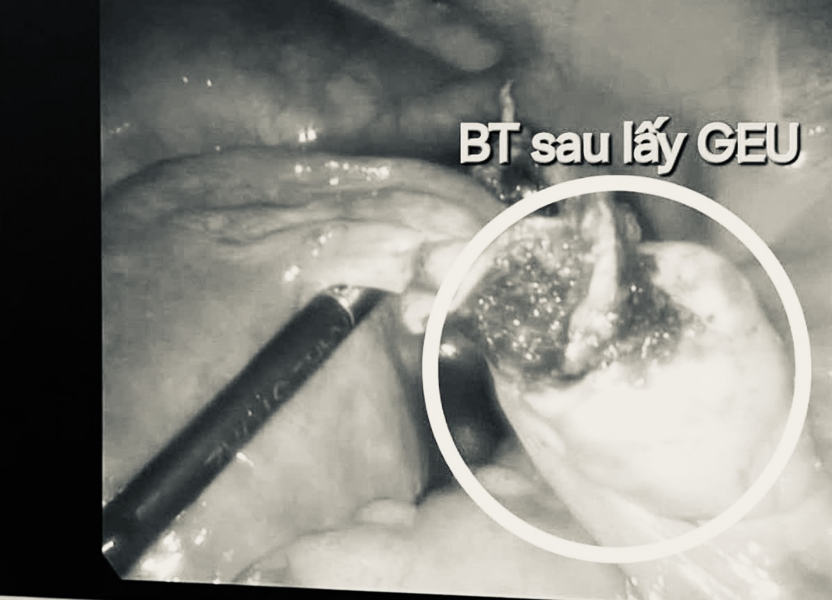 Doctors performed endoscopic surgery, removed the placenta from the right ovary and burned the bloody stasis. Photo: Provided by the hospital