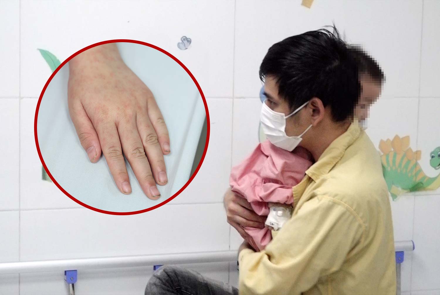 Measles can have serious complications, doctors only prevent it