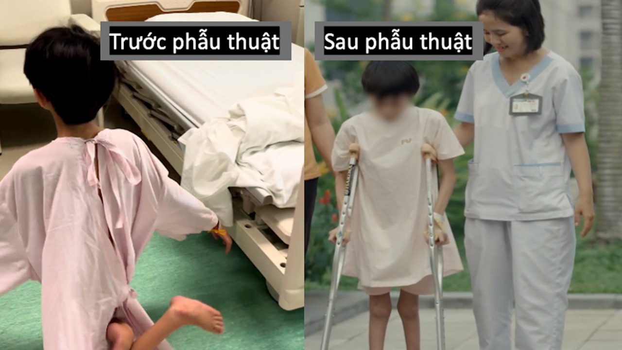 The patient underwent surgery to relieve her calves and short heels and was restored. Photo: Provided by the hospital