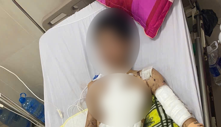 A male student in Quang Binh was seriously injured by homemade firecrackers and was hospitalized for emergency care. Photo: Vietnam - Cuba Dong Hoi Friendship Hospital