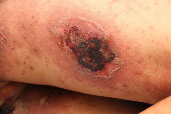 The ulcer was caused by a three-cavity monkey. Photo: BVCC