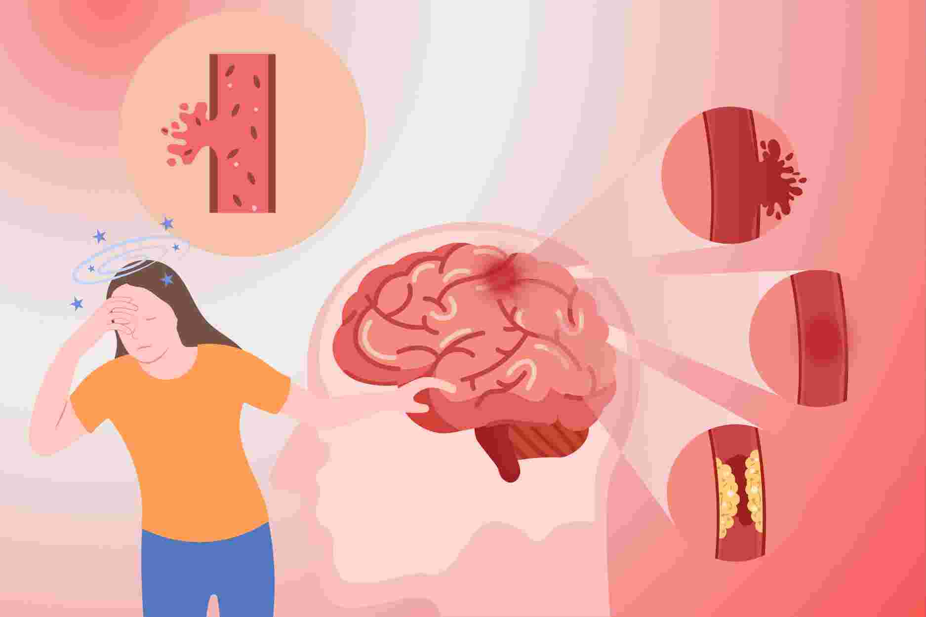 3 habits to do immediately to reduce the risk of stroke