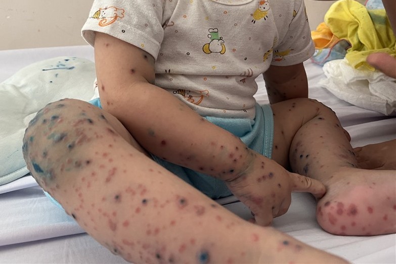 Children with hand, foot and mouth disease. Photo: Nguyen Ly