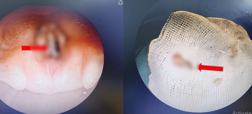 The foreign object is the piece of chicken bones when endoscoping the airway and when removed. Photo: BVCC