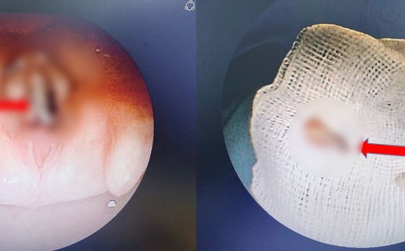 The foreign object is the piece of chicken bones when endoscoping the airway and when removed. Photo: BVCC