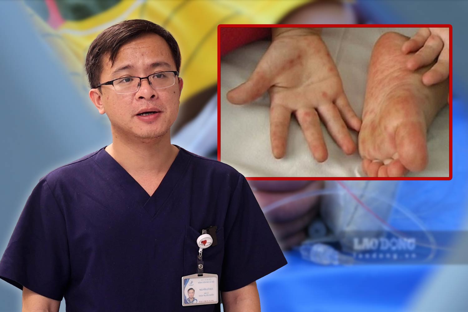 Without vaccines, doctors show how to prevent hand, foot and mouth disease