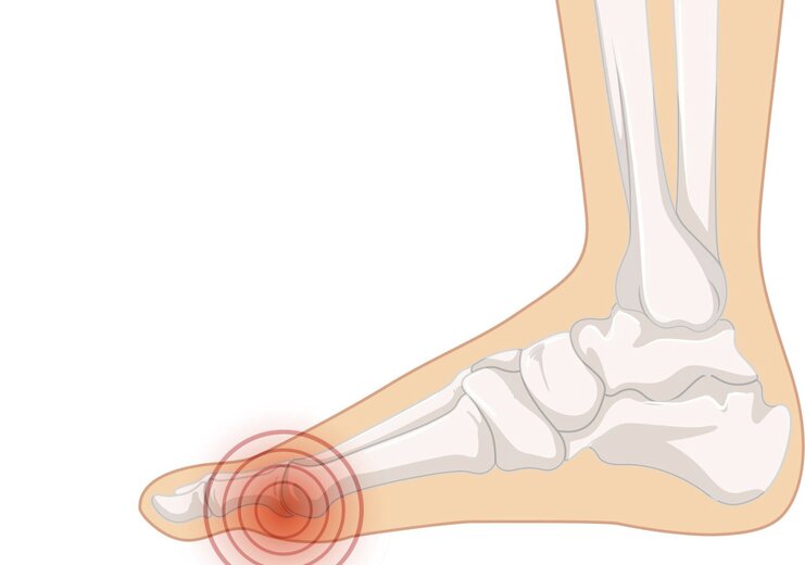 How should people with gout exercise? Graphics: Thuy Duong