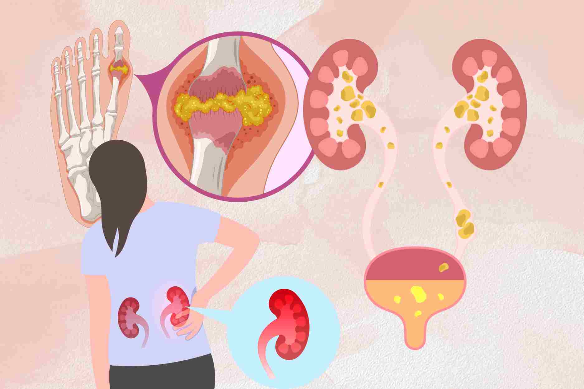 Be careful with 6 diseases that easily increase uric acid to protect your health. Graphics: Dinh Dinh