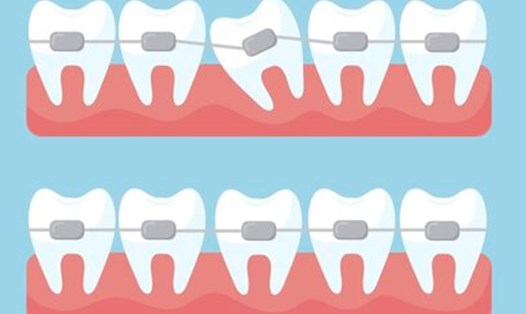 Niềng răng sớm cho trẻ cần lưu ý gì. Đồ họa: Thùy Dương