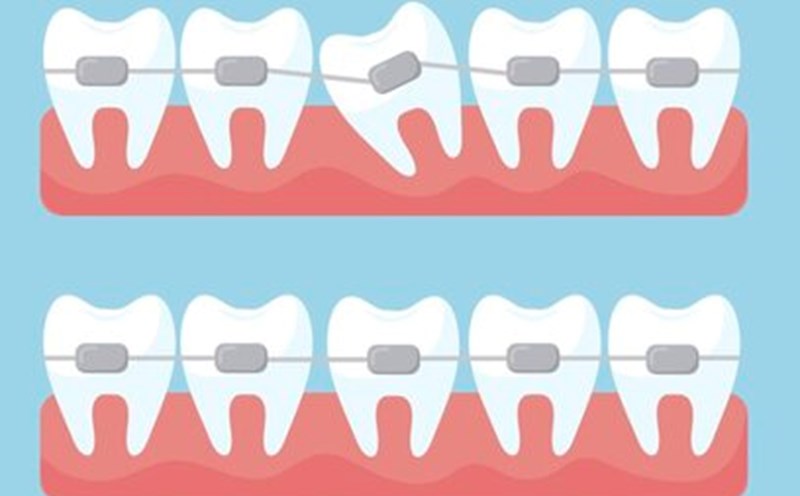 Early braces for children to note. Graphic: Thuy Duong