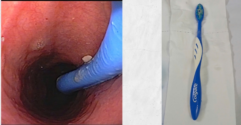 Doctors successfully pick up a 17cm long toothbrush from the patient's esophagus. Photo: Viet Tiep Nghiep Friendship Hospital