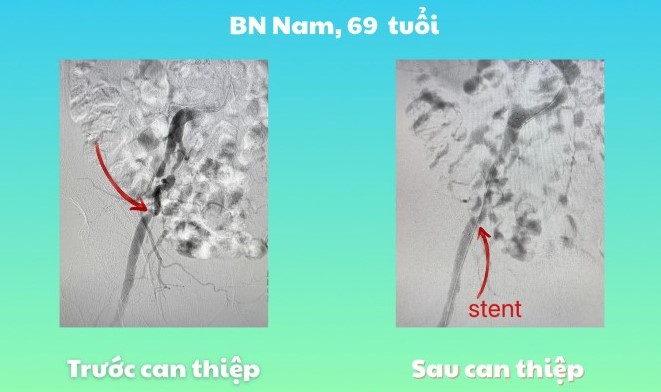Hinh anh truoc va sau can thiep cua benh nhan nam. Anh: BVCC